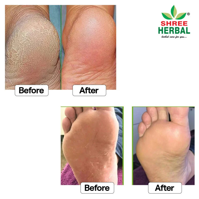 Foot Crack Cream - 100g