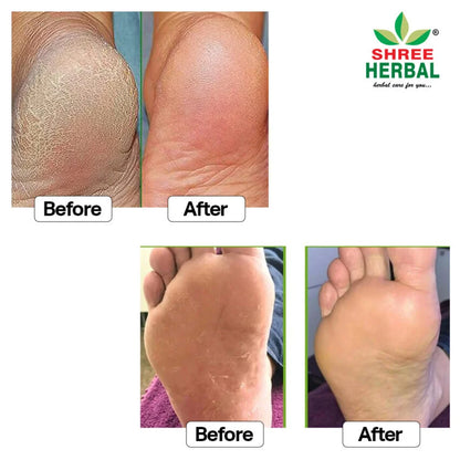 Foot Crack Cream - 100g